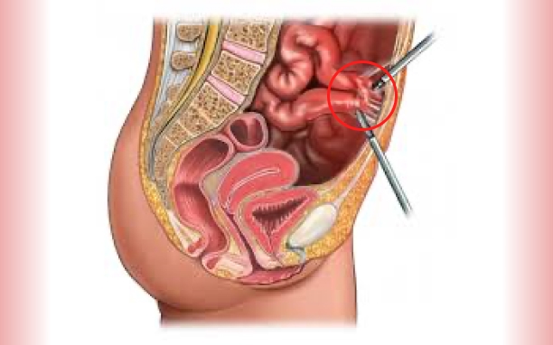 Laparoscopic Adhesiolysis